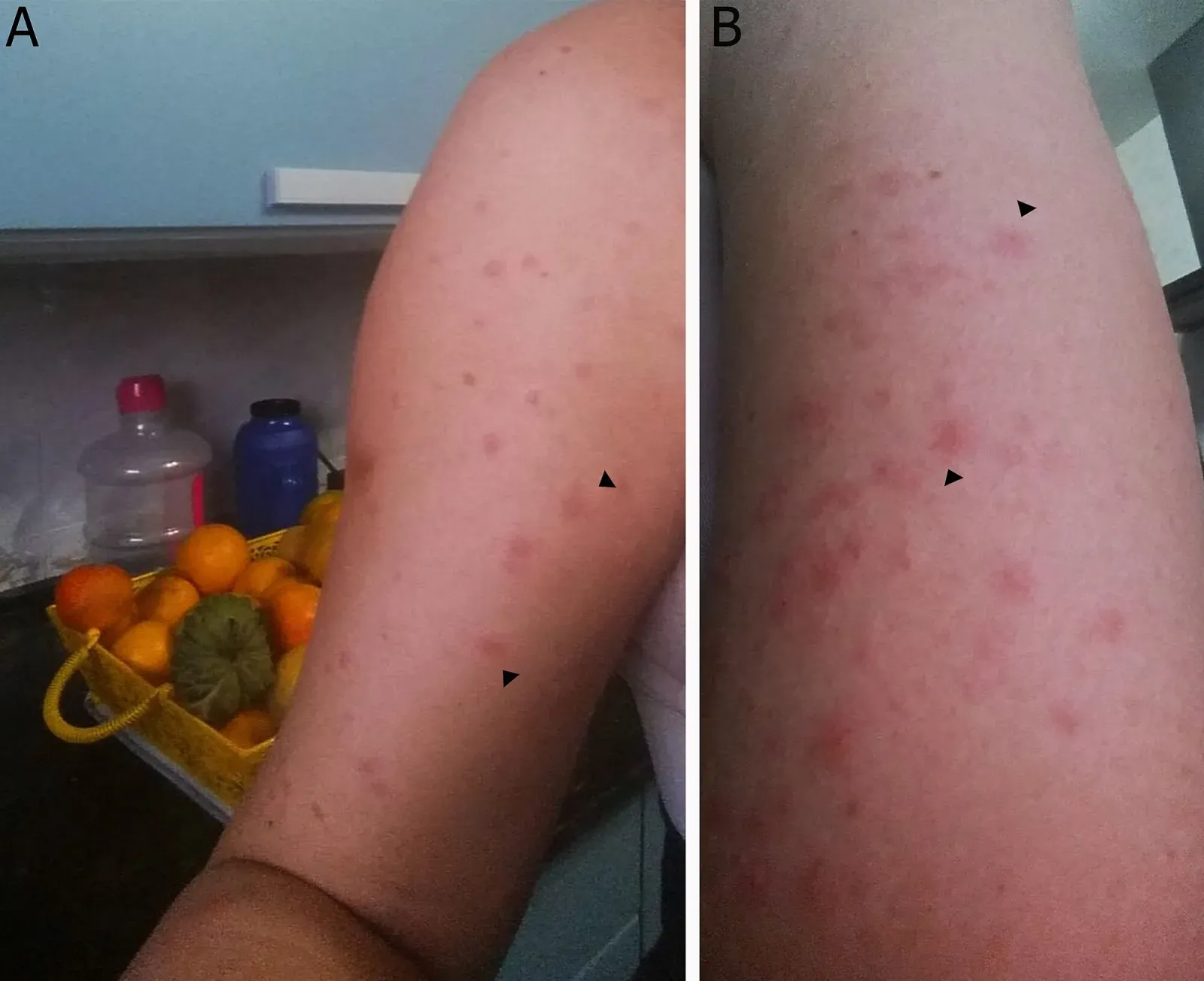 Two views of a person’s arm with scattered small red bumps from bird mite bites
