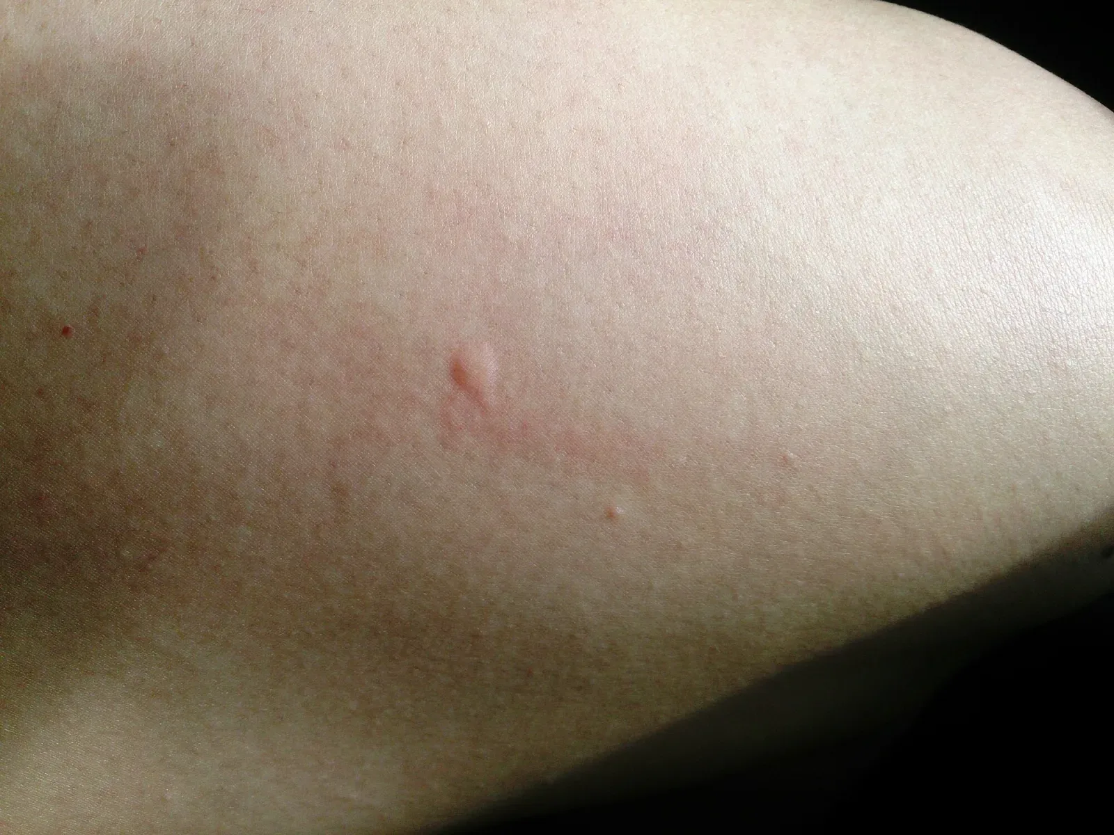 A single small, puffy mosquito bite with slight pink redness on a thigh