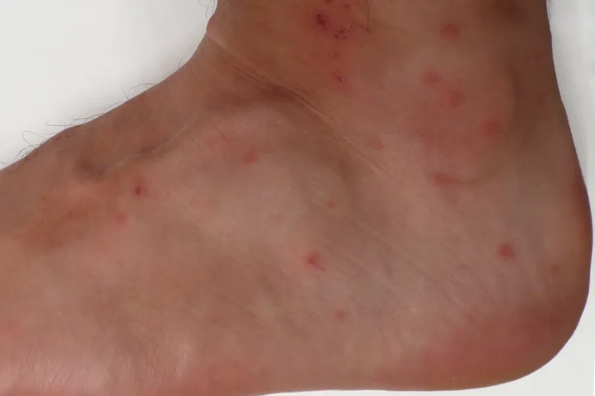 Chigger bites: clusters of small red, itchy bumps around the ankle