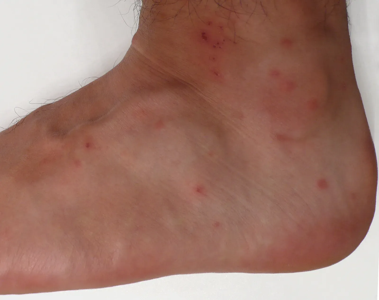 Small red bite bumps scattered across the top and side of a foot